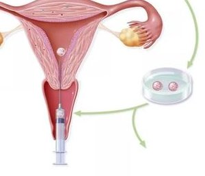 石家庄第一医院试管有望纳入医保，来算算新农合能报销多少